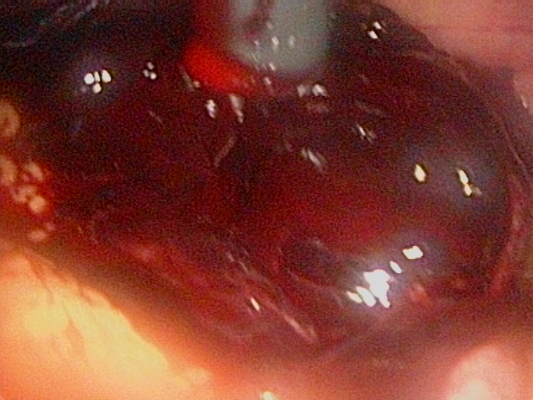 corpus luteum rupture sucking out blood